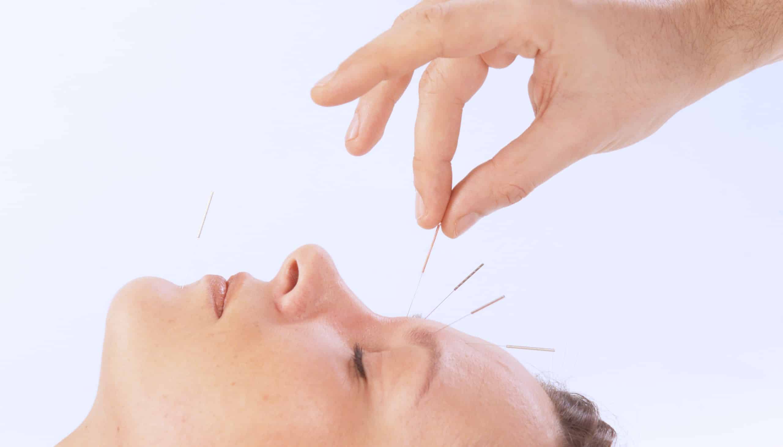 Akupunktur im Rahmen von nabomed